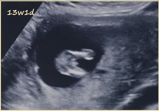 POST YOUR 12~13 week potty shot if you have one in Ultrasound Gender ...